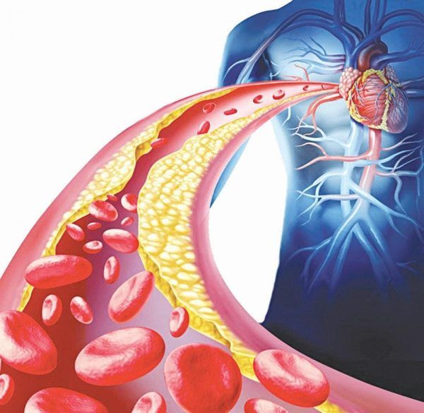 Mỡ máu cao là nguyên nhân chính dẫn đến các biến chứng về bệnh tim mạch, đột quỵ