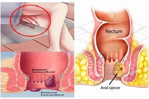 Ung thư hậu môn rất nguy hiểm nên cần phải phát hiện và điều trị sớm