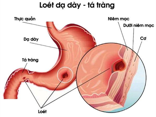 Có nhiều nguyên nhân gây viêm loét dạ dày tá tràng ở bệnh nhân