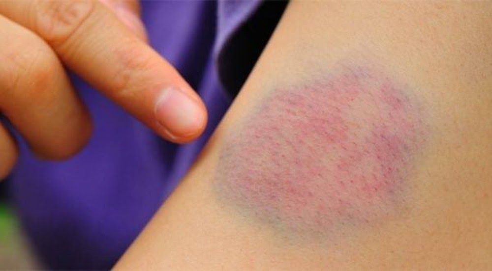 Xuất huyết dưới da là dấu hiệu ung thư máu điển hình