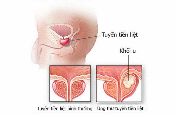 Ung thư tuyến tiền liệt là bệnh ung thư tương đối phổ biến ở nam giới