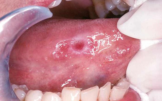 Dấu hiệu ung thư lưỡi ở giai đoạn cuối đã biểu hiện rõ rệt