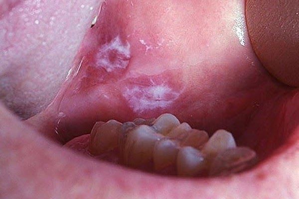 Trong miệng có xuất hiện các vết loét lâu ngày mãi không khỏi là dấu hiệu ung thư miệng phổ biến