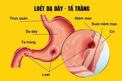Điều trị viêm loét dạ dày tá tràng bằng thuốc kháng acid để giảm bớt các triệu chứng khó chịu trong thời gian ngắn hạn