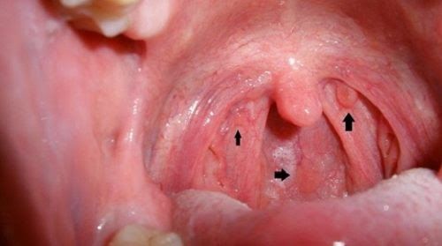 là bệnh ung thư phát sinh từ các tế bào vòm họng (phần cao nhất của hầu họng, ngay phía sau mũi)