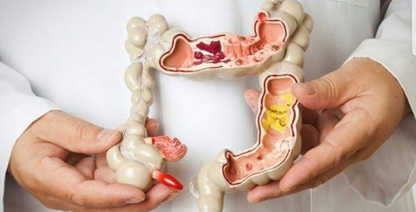 Các nhà khoa học chưa xác định được chính xác nguyên nhân ung thư đại tràng