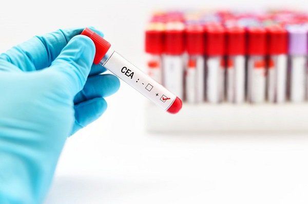 Xét nghiệm CEA giúp phát hiện ung thư đại tràng