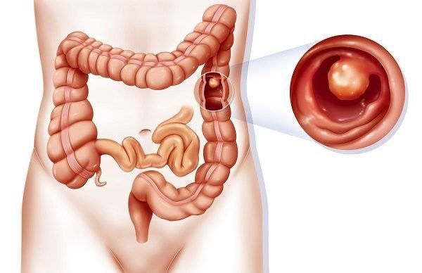 Người có tiền sử polyp đại tràng có nguy cơ mắc ung thư cao