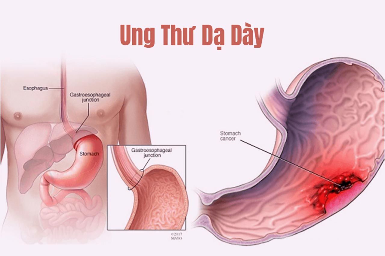 Ung thư dạ dày là bệnh ung thư phổ biến nhất trong các bệnh ung thư đường tiêu hóa