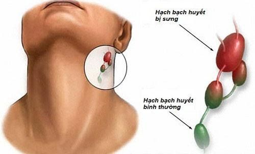 Ung thư hạch bạch huyết là bệnh nguy hiểm nên cần được phát hiện và điều trị sớm