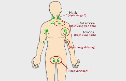 Hạch bạch huyết còn gọi là hạch lympho nằm rải rác ở mạch bạch huyết và là một phần của hệ bạch huyết