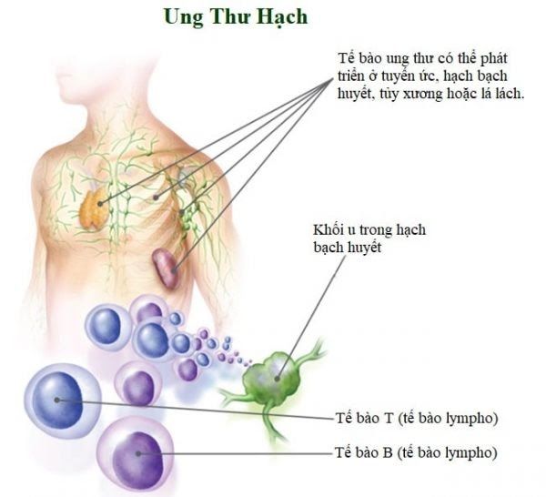 Hạch bạch huyết có thể gây ung thư khi chúng có chứa các tế bào bạch huyết ác tính