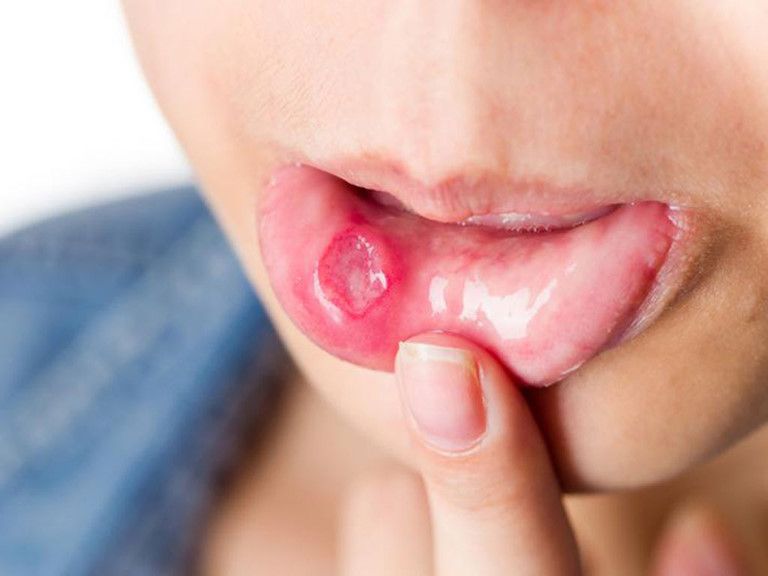 Ung thư miệng là một dạng tổn thương có dạng loét, cứng hoặc chồi sùi