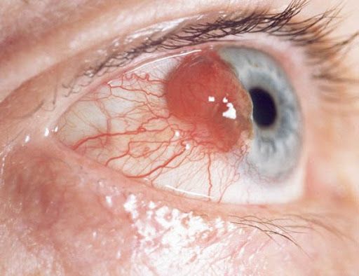 Bệnh ung thư mắt sẽ gây ảnh hưởng tới thị lực, khiến mắt nhìn mờ, khó nhìn