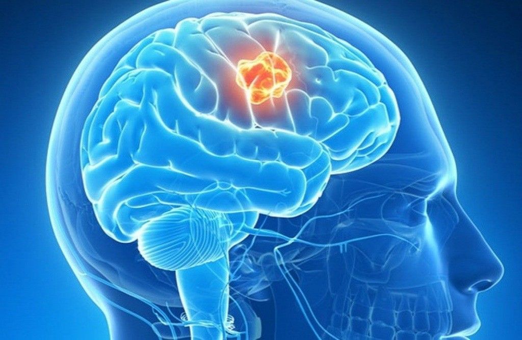 Ung thư não và triệu chứng của nó có thể bị hiểu nhầm là đau đầu bình thường khiến người bệnh chủ quan