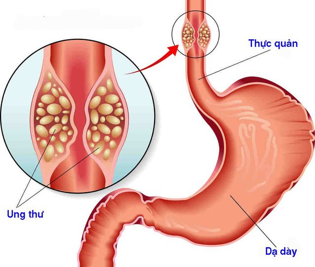 Ung thư thực quản có chữa được không là mối quan tâm của bệnh nhân và người nhà