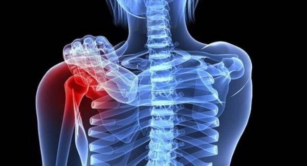 Ung thư xương là bệnh lý ác tính bắt nguồn ở xương
