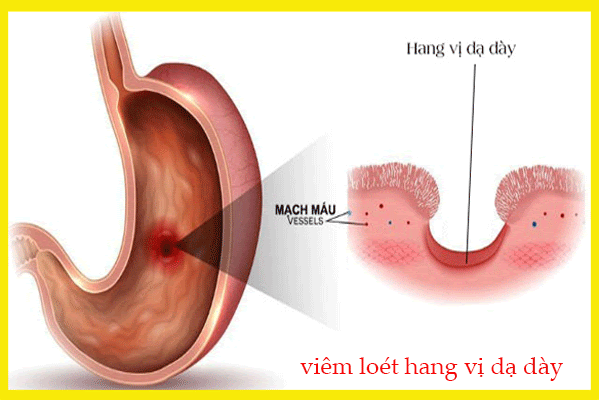 Bệnh viêm loét hang vị dạ dày nếu để lâu không được phát hiện sớm sẽ gây ra những biến chứng nguy hiểm