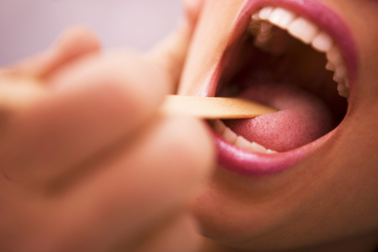 Biểu hiện ung thư vòm họng giai đoạn sớm thường không rõ rệt