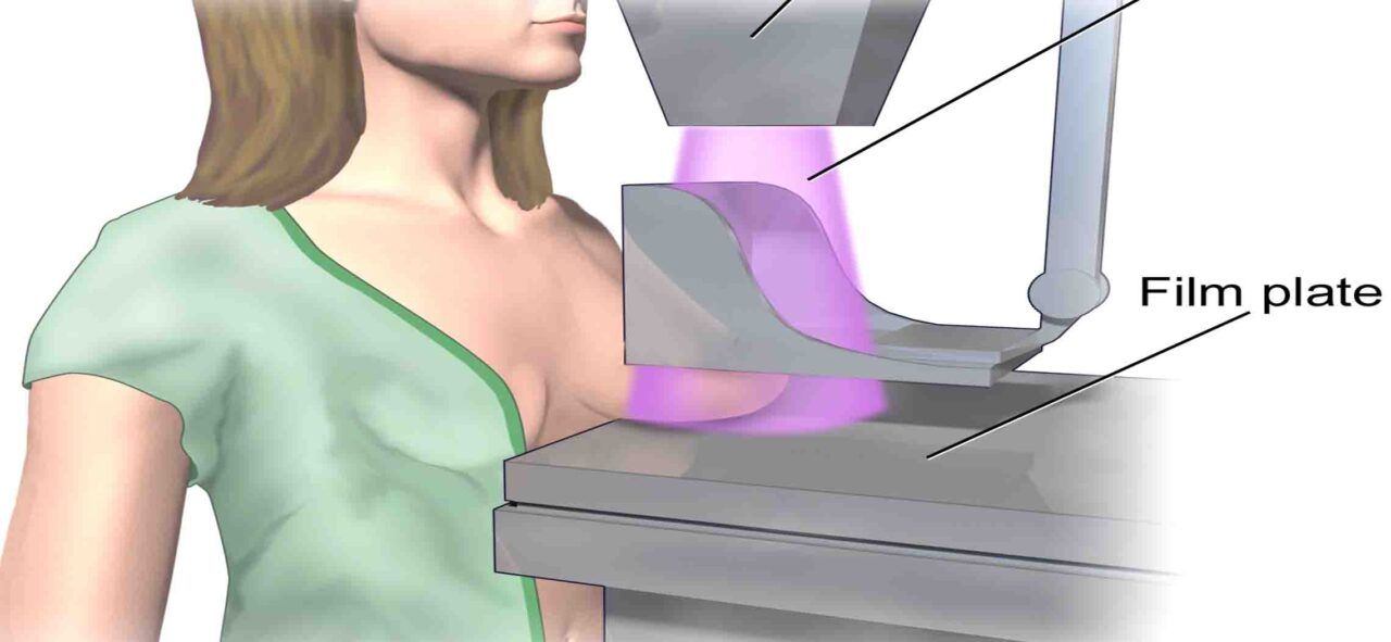 Chụp X-quang tuyến vú là một trong những cách phát hiện ung thư vú sớm