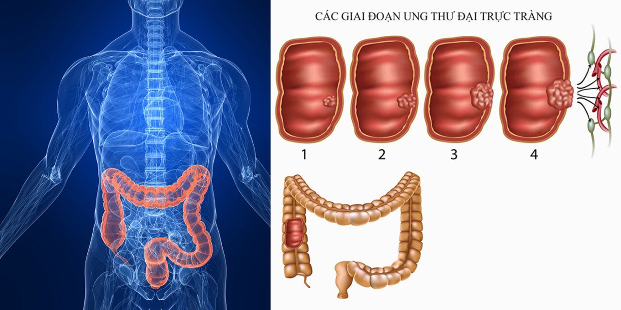 Ung thư đại trực tràng là loại bệnh lý có tỷ lệ tử vong cao