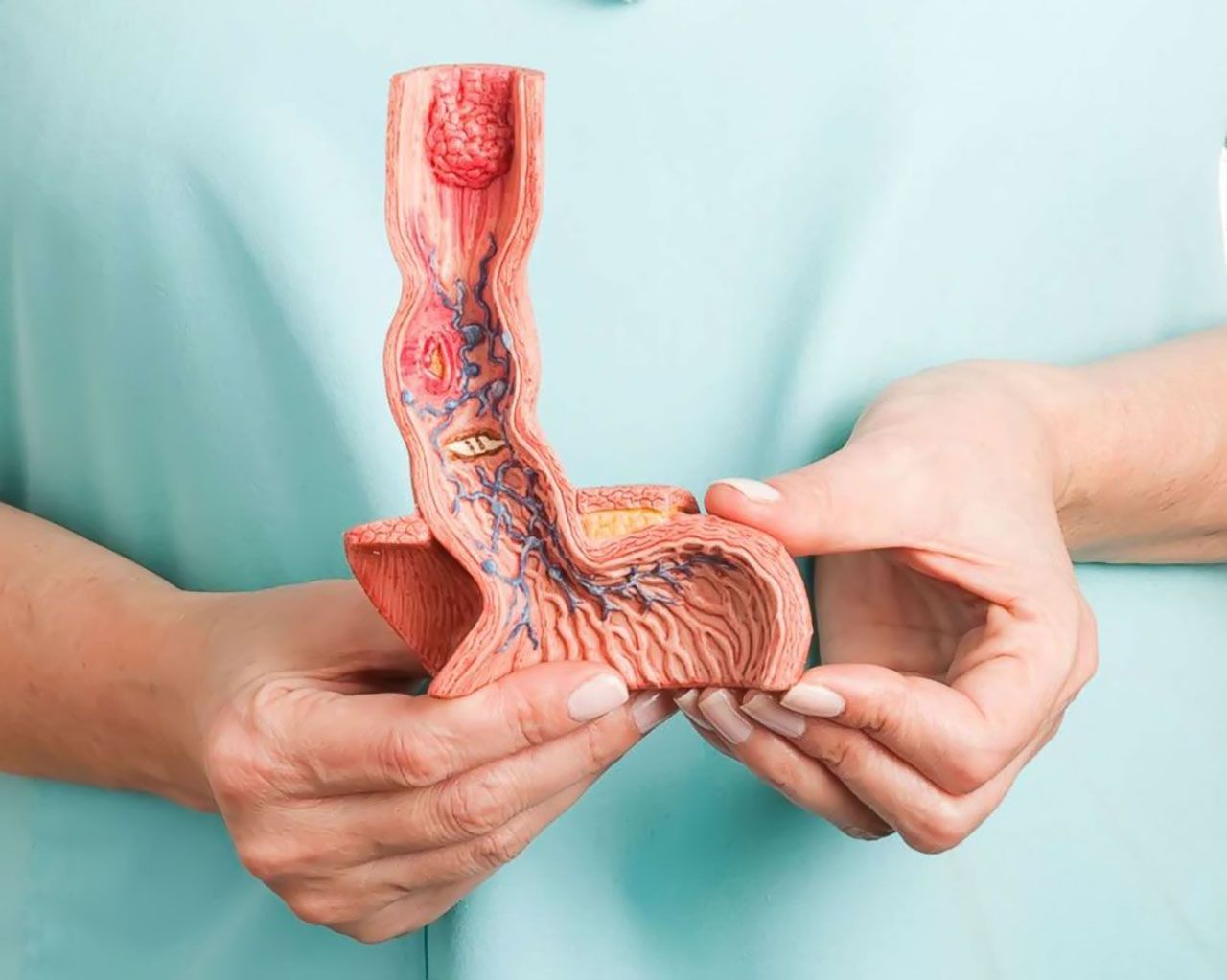 Ung thư thực quản phát sinh từ thực quản – đoạn ống tiêu hóa giữa cổ họng và dạ dày