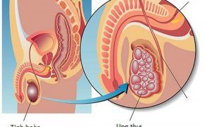 8 biểu hiện của ung thư tinh hoàn và phương pháp điều trị