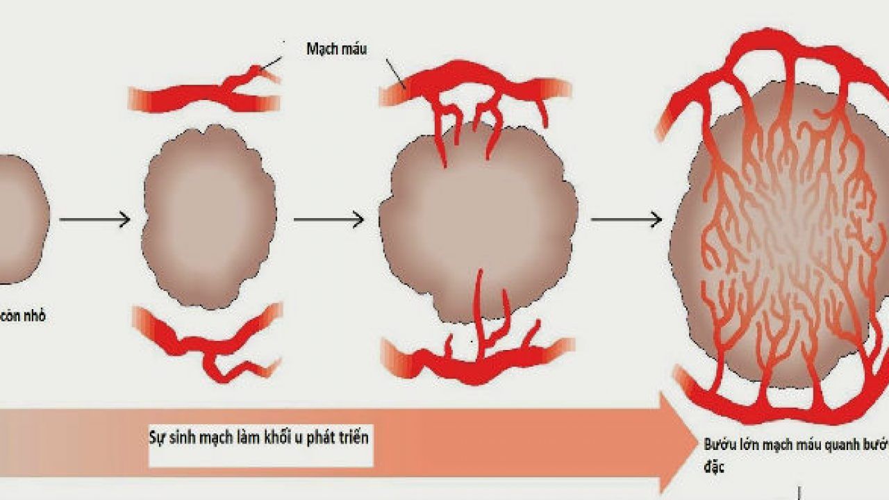 Fucoidan giúp ngăn chặn hình thành mạch máu mới nuôi dưỡng tế bào ung thư