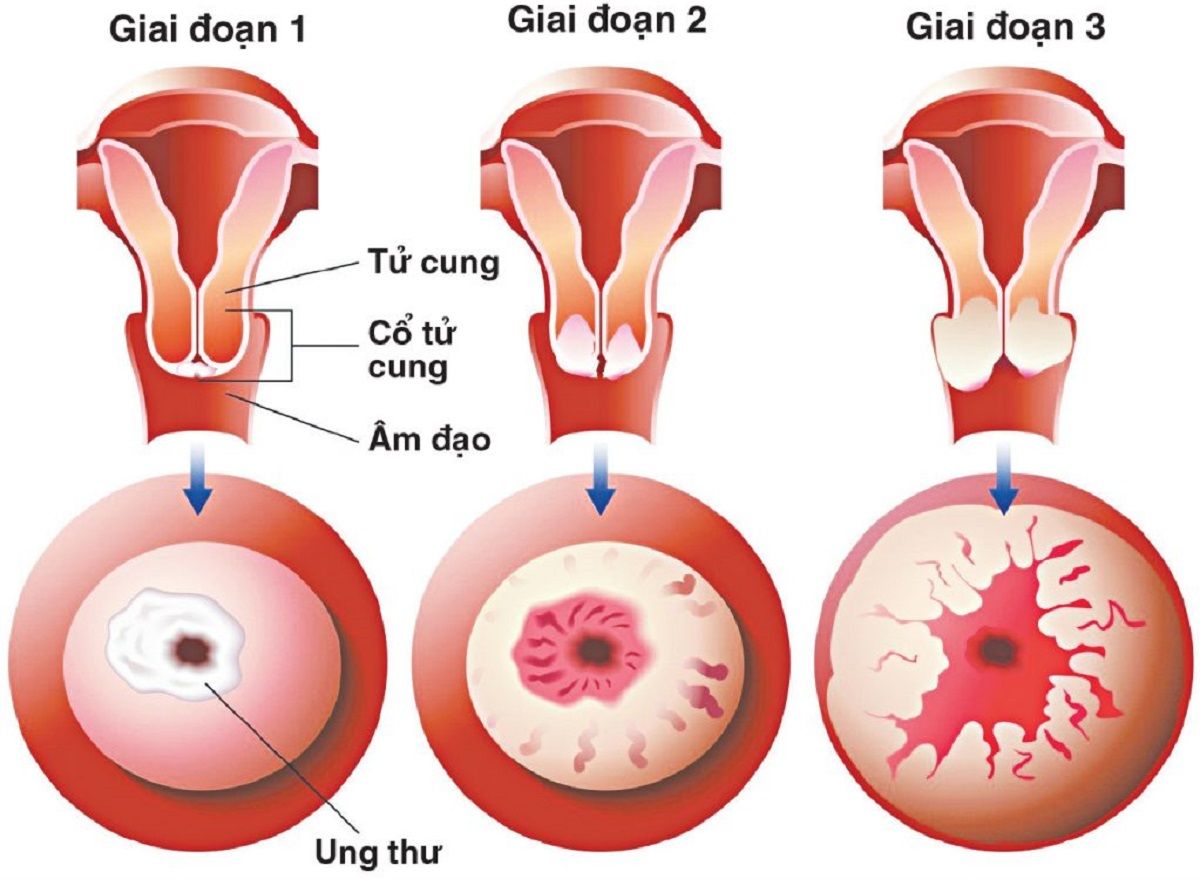 Ung thư cổ tử cung là bệnh lý ác tính hình thành trong các mô cổ tử cung