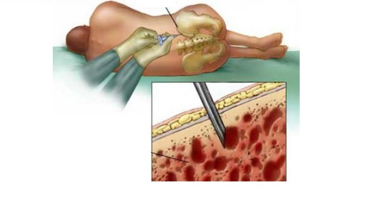 Sinh thiết tủy xương là một trong những xét nghiệm ung thư máu quan trọng
