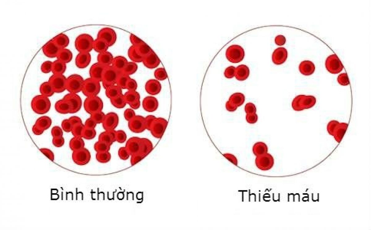 Thiếu máu là một trong những tác dụng phụ của hóa trị ung thư