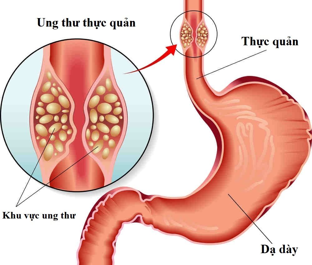 Ung thư thực quản di căn là khi ung thư đã lây lan sang các bộ phận khác của cơ thể