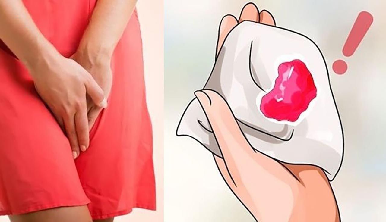 Chảy máu ân đạo bất thường là một trong những dấu hiệu ung thư cổ tử cung