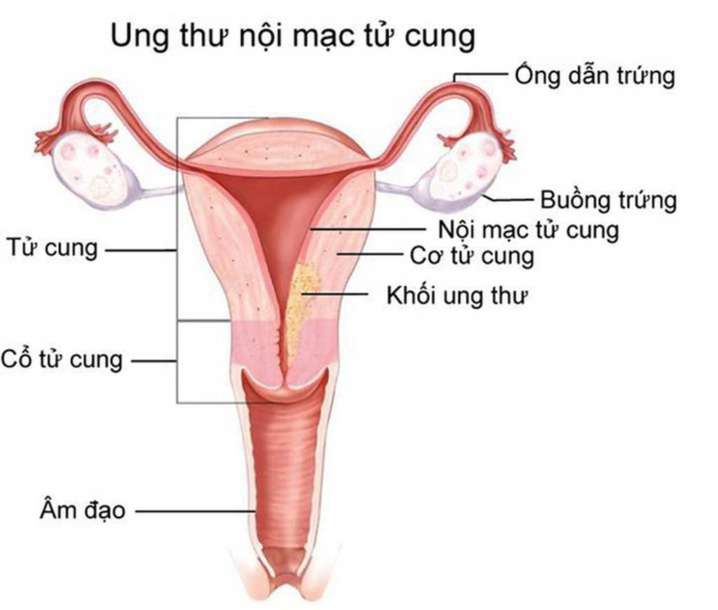 Ung thư nội mạc tử cung hình thành do các khối u ác tính phát triển từ niêm mạc tử cung 