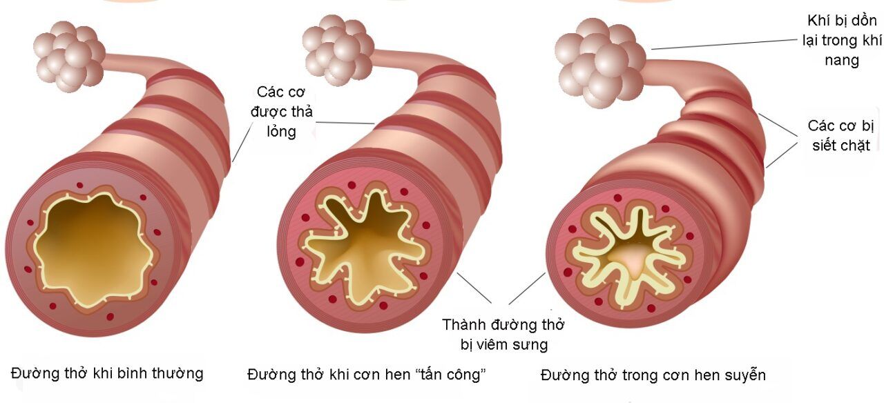 Ung thư phế quản xuất hiện do sự phát triển bất thường và gia tăng đột biến của các tế bào trong phế quản