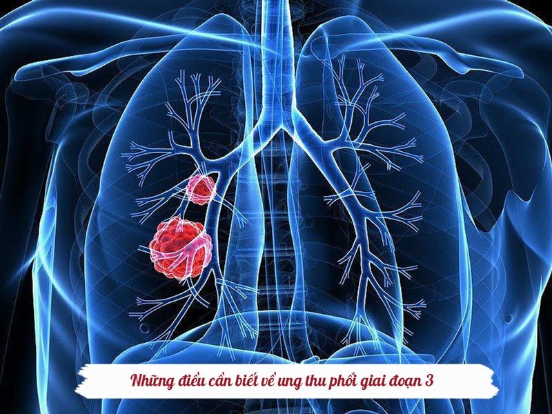 Ung thư phổi giai đoạn 3 cần được điều trị tích cực