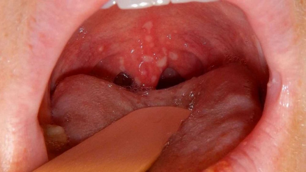 Hình ảnh ung thư vòm họng giai đoạn 3