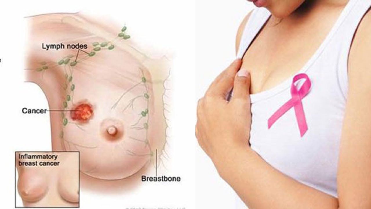 Ung thư vú bắt đầu từ sự tăng trưởng không kiểm soát của các tế bào ở vú