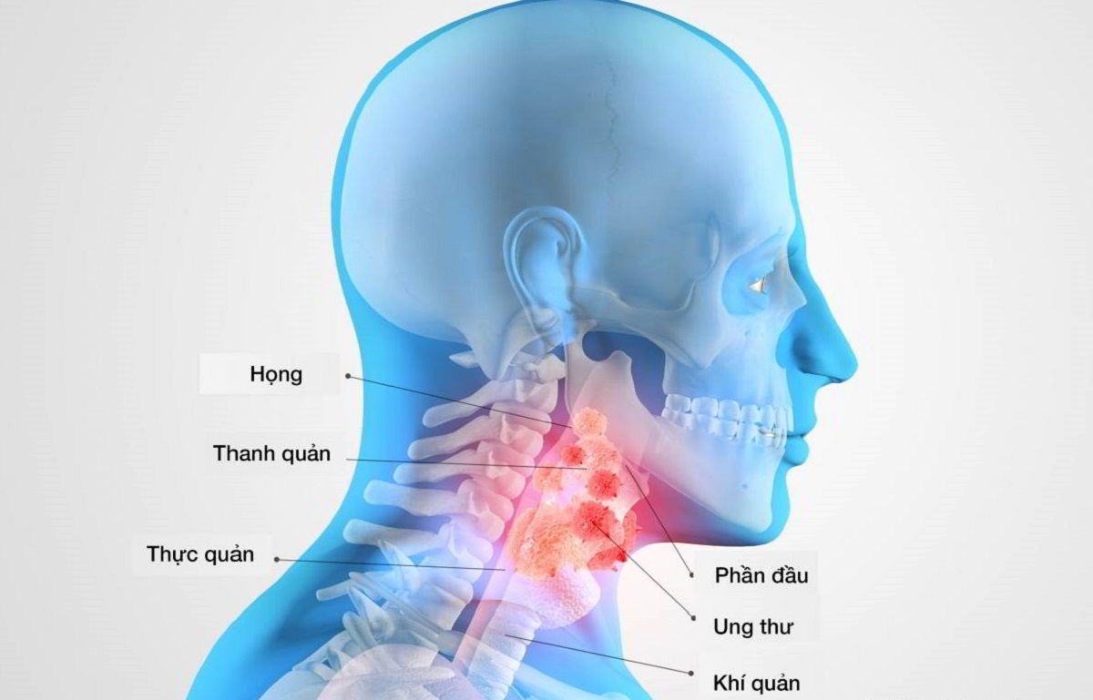 Ung thư vòm họng giai đoạn cuối là cụm từ biểu hiện cấp độ bệnh nặng nhất của bệnh ung thư vòm họng