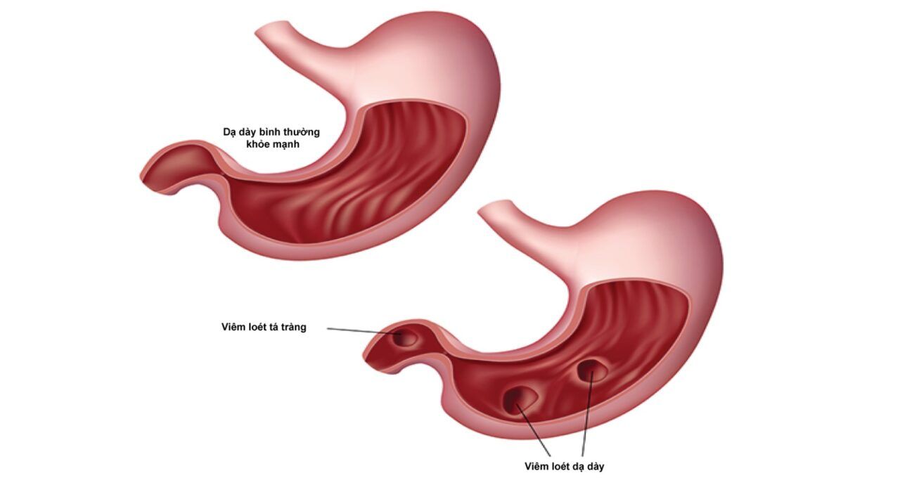 Viêm loét dạ dày là gì? Là tình trạng tổn thương một hay nhiều vùng niêm mạc dạ dày tá tràng, phá hỏng cấu trúc mô học của cơ quan này