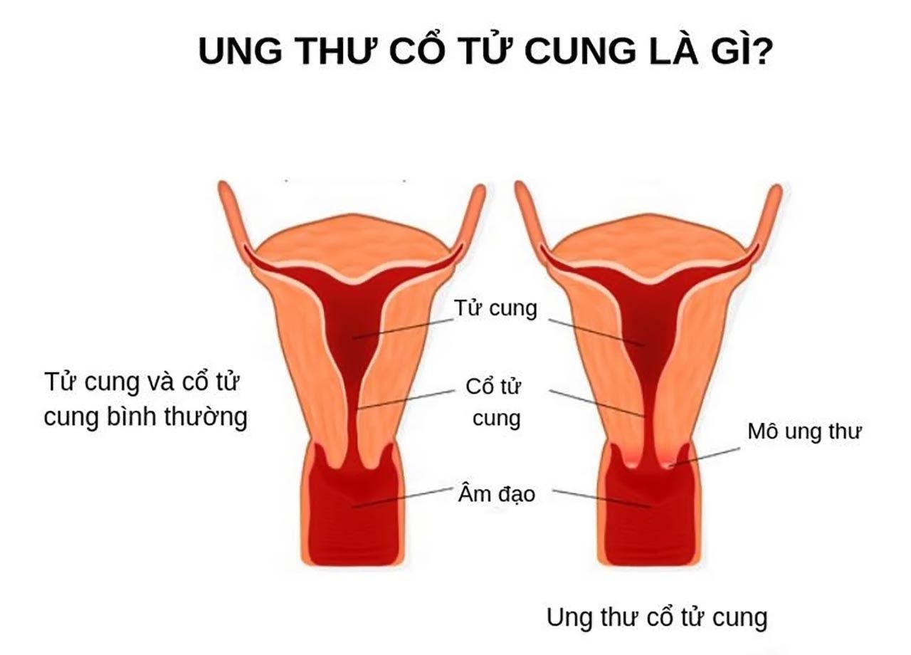 Dấu hiệu bệnh ung thư cổ tử cung giai đoạn cuối dễ dàng quan sát và nhận biết hơn