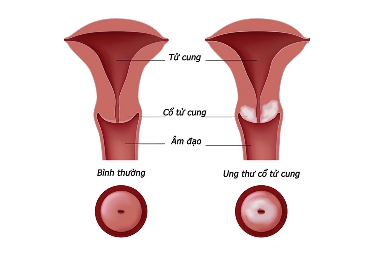 Bệnh ung thư cổ tử cung là căn bệnh nguy hiểm