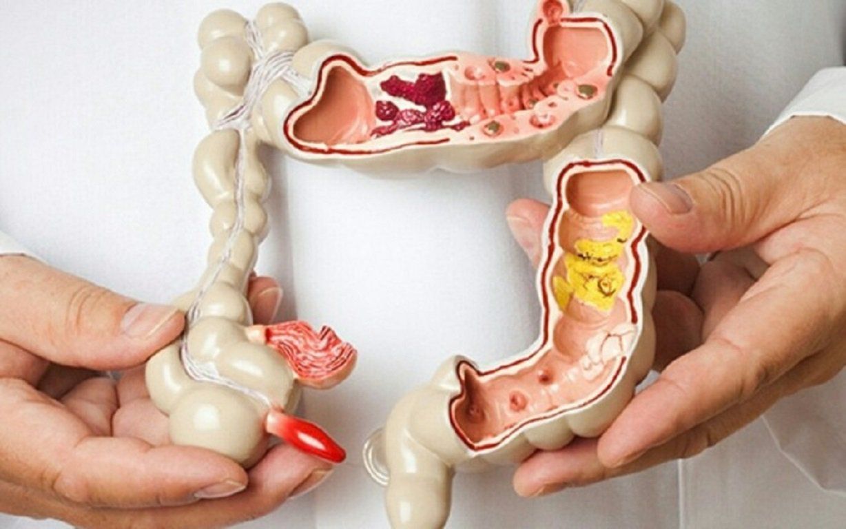 Ung thư đại tràng bắt đầu từ polyp trên bề mặt bên trong của đại tràng