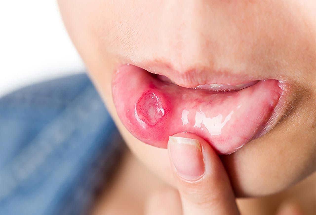 Một trong các tác dụng phụ khi hóa trị là loét miệng