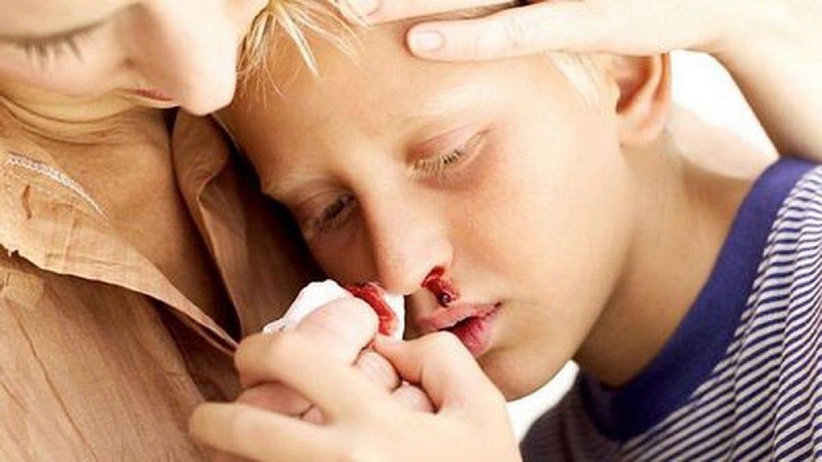 Chảy máu cam là một trong những dấu hiệu của ung thư máu