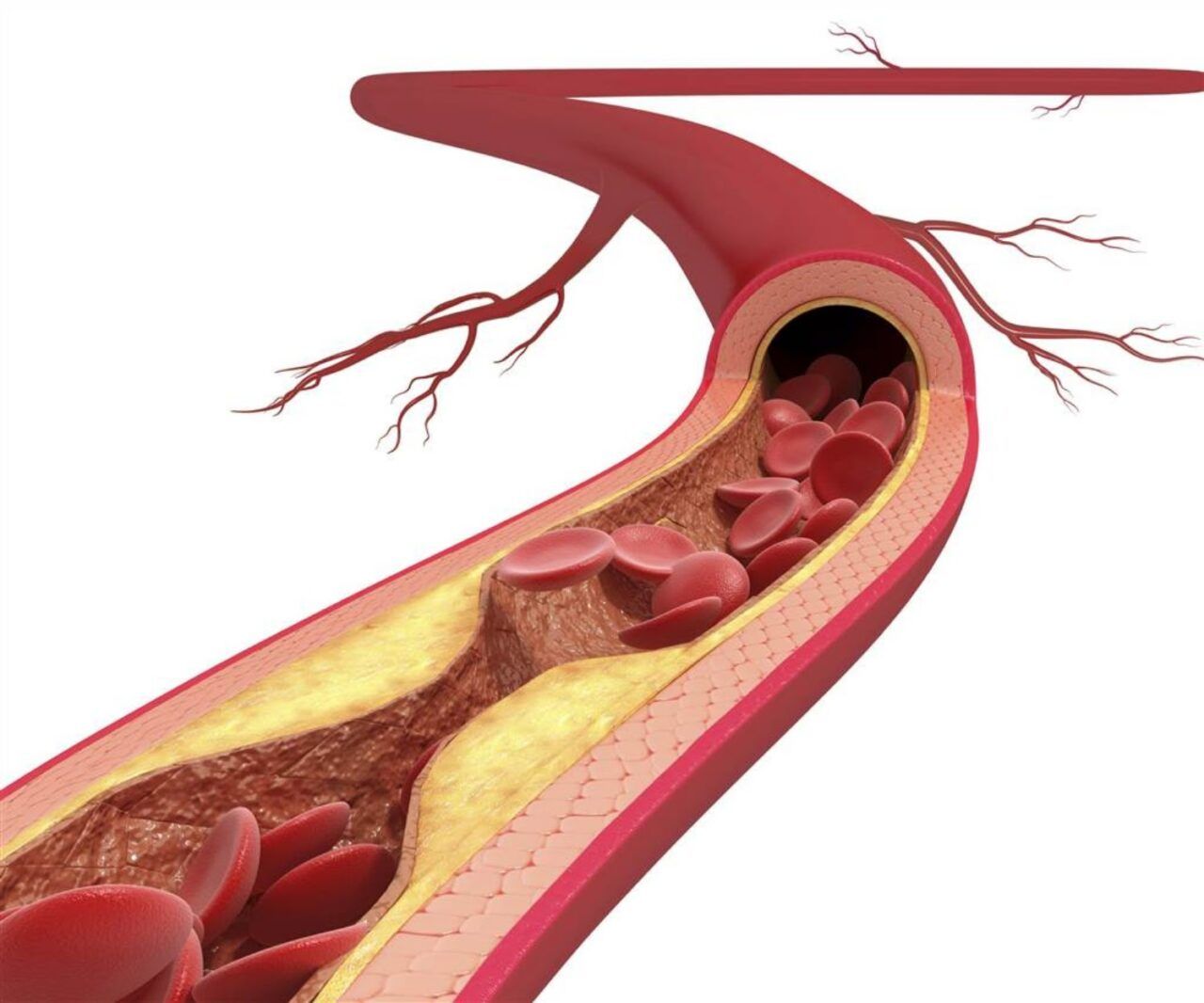 Xơ vữa động mạch do cholesterol cao không được điều trị kịp thời