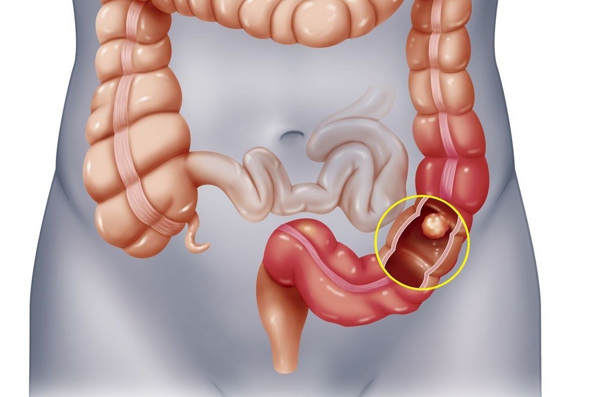 Ung thư đại tràng được chia ra làm 4 giai đoạn