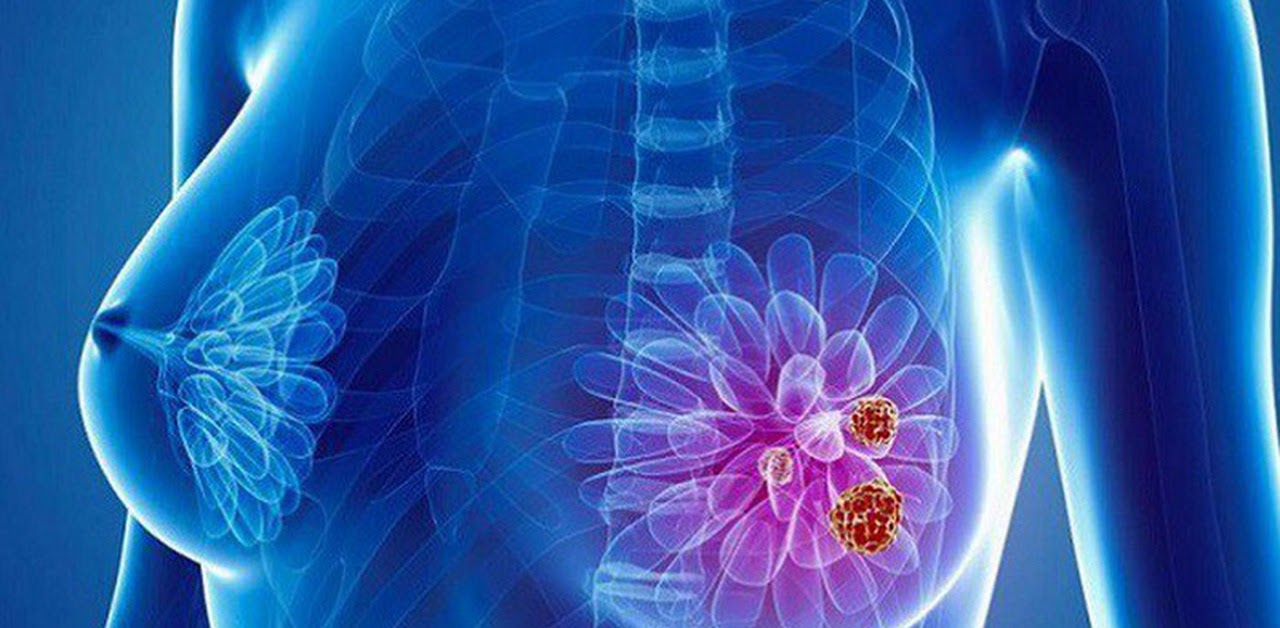 Cho đến nay các nhà nghiên cứu vẫn chưa tìm ra nguyên nhân ung thư vú
