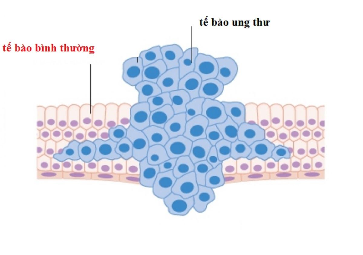 Sự phát triển của tế bào ung thư