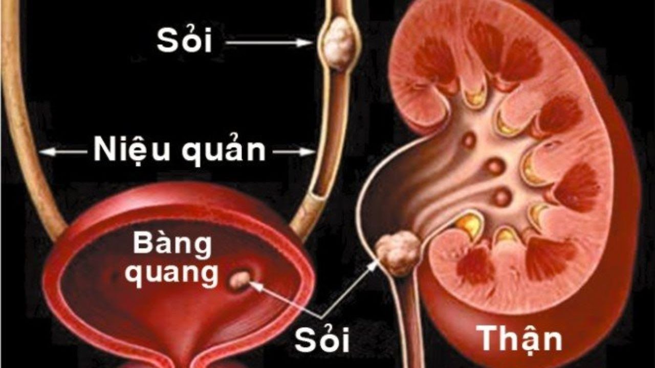 Ung thư bàng quang